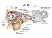 Acquired oculomotor nerve palsy in childhood - SCHWANNOMA