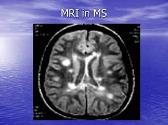 DEMYELINATING DISEASE MULTIPLE SCLEROSIS