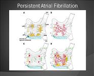 Atrial Fibrillation-Current Evaluation and Management PowerPoint Presentation