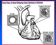 Arteriosclerosis and Coronary Heart Disease-CHD PowerPoint Presentation