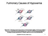 Acute Respiratory Failure