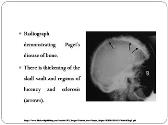 X Rays of Metabolic Bone Diseases