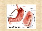 Peptic Ulcer Disease