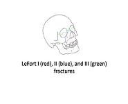 Le Fort fracture of skull PowerPoint Presentation