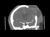 Neurologic Emergencies