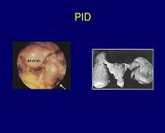 Pelvic Inflammatory Disease-PID PowerPoint Presentation