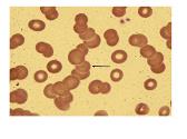 Erythrocyte Sedimentation Rate-ESR