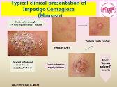 Dermatologic Infections in Children